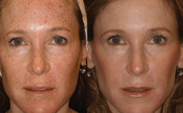Advanced Light Therapy Guide for Clear, Radiant Skin Results