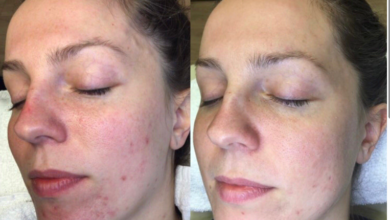 Complete Guide to Radiant Skin with Advanced Laser Solutions Complete Guide to Radiant Skin with Advanced Laser Solutions