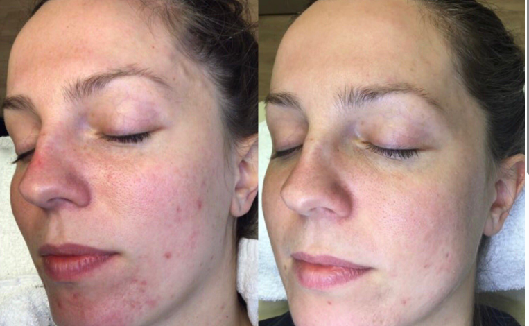 Complete Guide to Radiant Skin with Advanced Laser Solutions